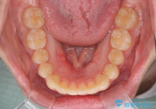 前歯のねじれをマウスピース矯正で治したいの治療後