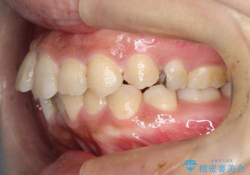 【ワイヤー矯正】前歯の凸凹を治したいの治療前