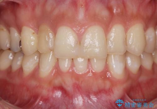 充填物の変色を繰り返す前歯のセラミック治療の治療前
