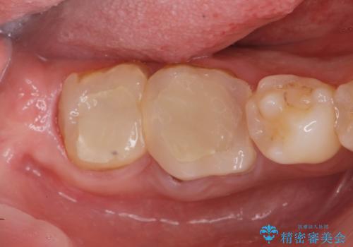 スペース狭小な銀歯を白くしたい 歯冠長延長術を併用したセラミック治療の治療中