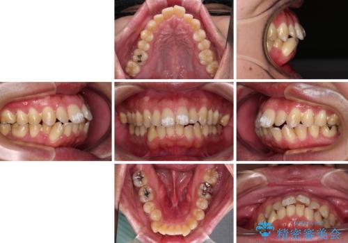 口が閉じられない 抜歯矯正で前歯の突出感を改善の治療前