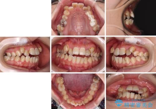 むし歯と八重歯を治したい 総合歯科治療の治療前
