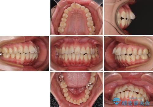 【モニター】口が閉じられない ワイヤー装置での抜歯矯正の治療前