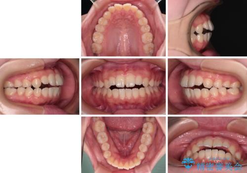 【モニター】舌突出癖で隙間が ワイヤー装置での抜歯矯正の治療前