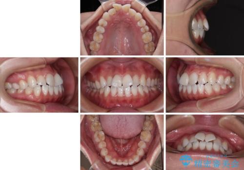 捻れた前歯を楽して改善 ワイヤー装置での非抜歯矯正の治療前