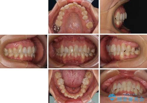 前歯のデコボコとむし歯治療の跡 インビザライン矯正とオールセラミッククラウン治療の治療前