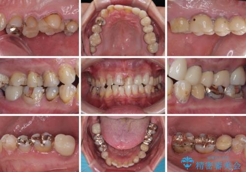 受け口傾向の咬み合わせを治したい 全顎セラミック治療の治療前