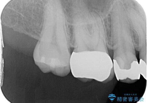 銀歯をセラミックに変えたいの治療後