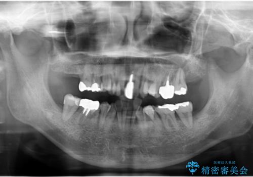歯周病 、インプラント、 矯正 全顎治療の治療前