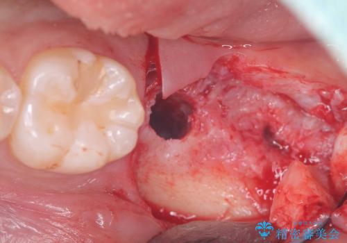 痛くないインプラント治療|1回の手術で終了!|エンドペリオ病変|オールセラミッククラウンの治療中