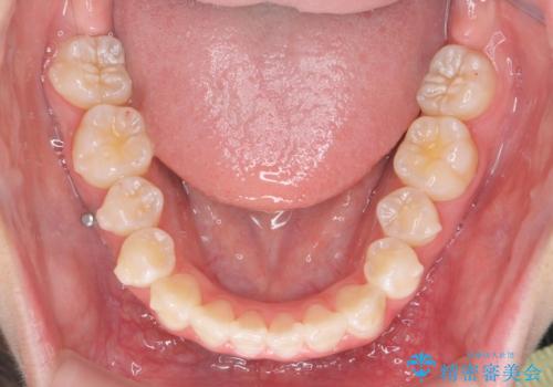 上下すれ違った前歯の矯正治療の治療中