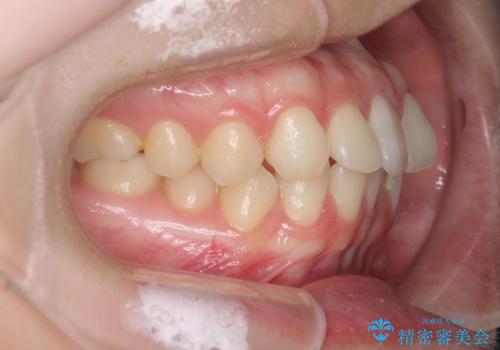 前歯のねじれをマウスピース矯正で治したいの治療前