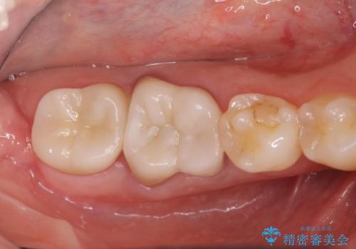 スペース狭小な銀歯を白くしたい 歯冠長延長術を併用したセラミック治療の治療後