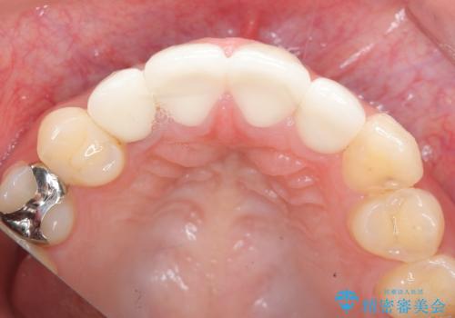 充填物の変色を繰り返す前歯のセラミック治療の治療後