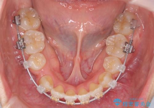 突き出た前歯を治したい 小臼歯抜歯+マルチブラケット矯正の治療中