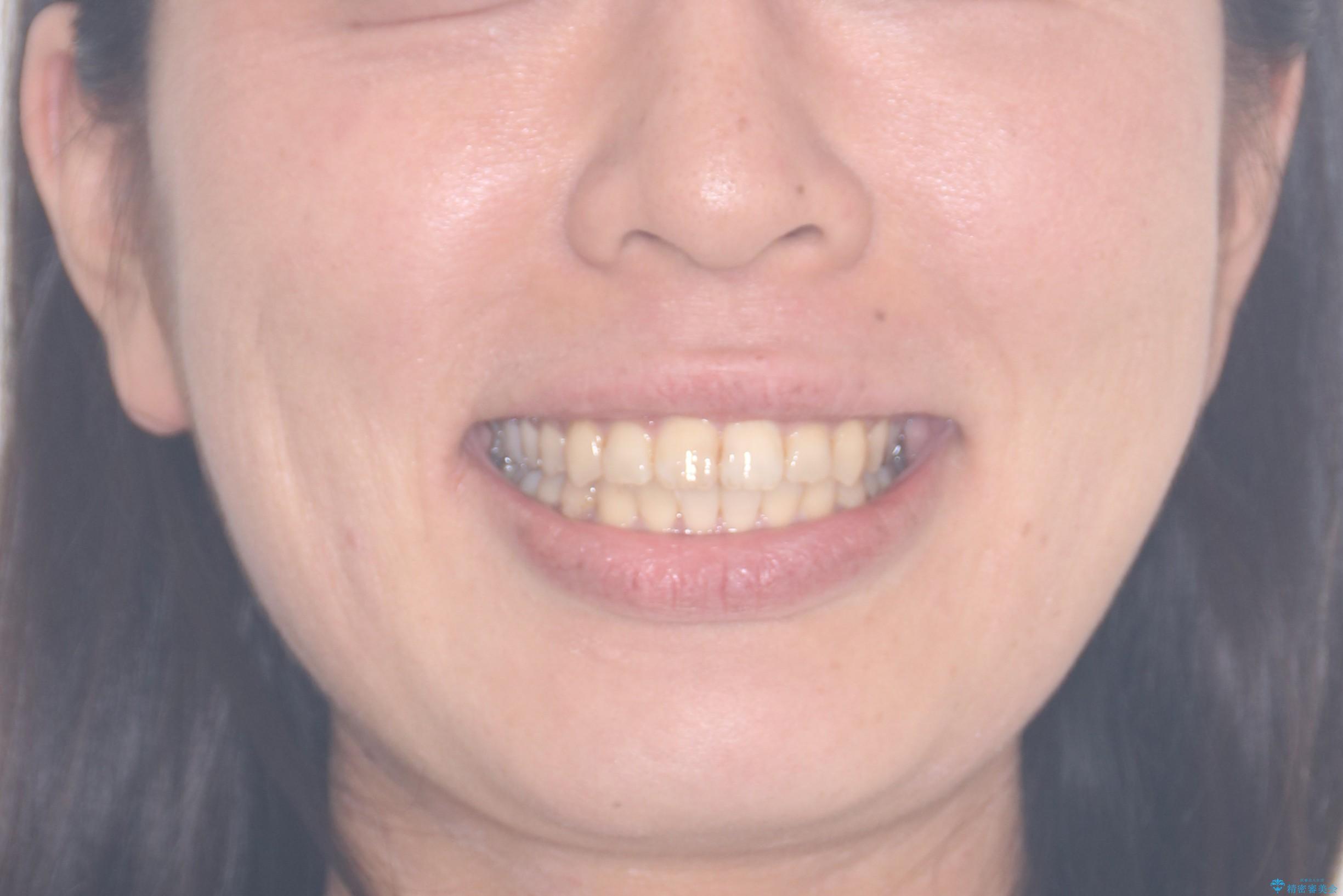 【ワイヤー矯正】前歯の凸凹を治したいの治療後(顔貌)