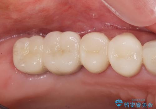 ブリッジのぐらつき インプラントを用いた奥歯の噛み合わせの再構築の治療後