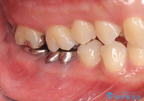 スペース狭小な銀歯を白くしたい 歯冠長延長術を併用したセラミック治療の治療前