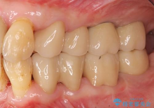 歯周病 、インプラント、 矯正 全顎治療の治療後