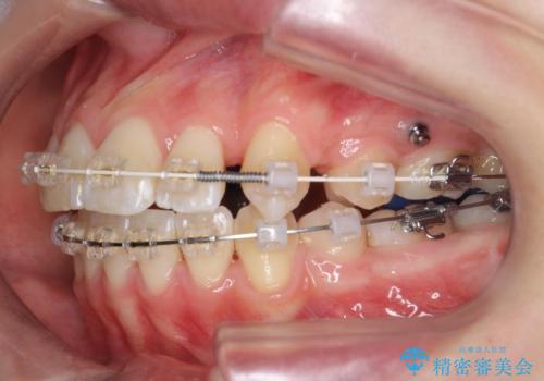 突き出た前歯を治したい 小臼歯抜歯+マルチブラケット矯正の治療中