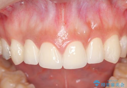 充填物の変色を繰り返す前歯のセラミック治療の治療後