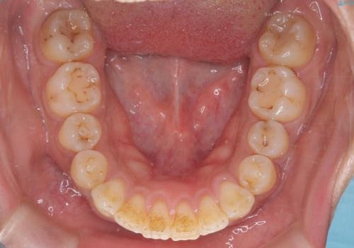 【ワイヤー矯正】前歯の凸凹を治したいの治療後