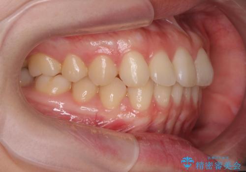 前歯のねじれをマウスピース矯正で治したいの治療後