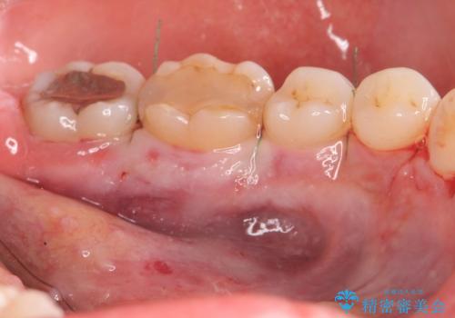 話すのに邪魔な、下顎骨隆起の切除の症例 治療後