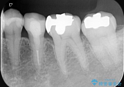 銀歯を白くしたい セラミックインレーの治療前
