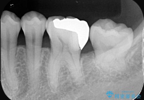 銀歯の下の虫歯|生活歯髄療法|VPT|神経を残すための治療|セラッミクインレーの治療前