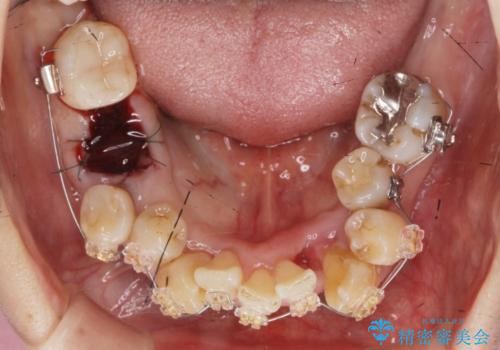 歯周病 、インプラント、 矯正 全顎治療の治療中