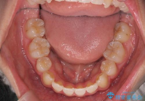 突き出た前歯を治したい 小臼歯抜歯+マルチブラケット矯正の治療後