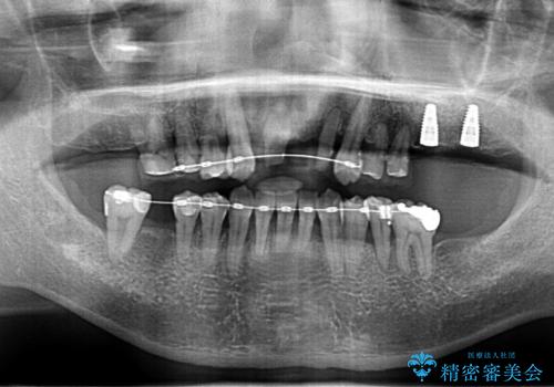 歯周病 、インプラント、 矯正 全顎治療の治療中