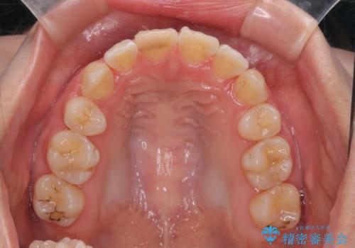 突き出た前歯を治したい 小臼歯抜歯+マルチブラケット矯正の治療後