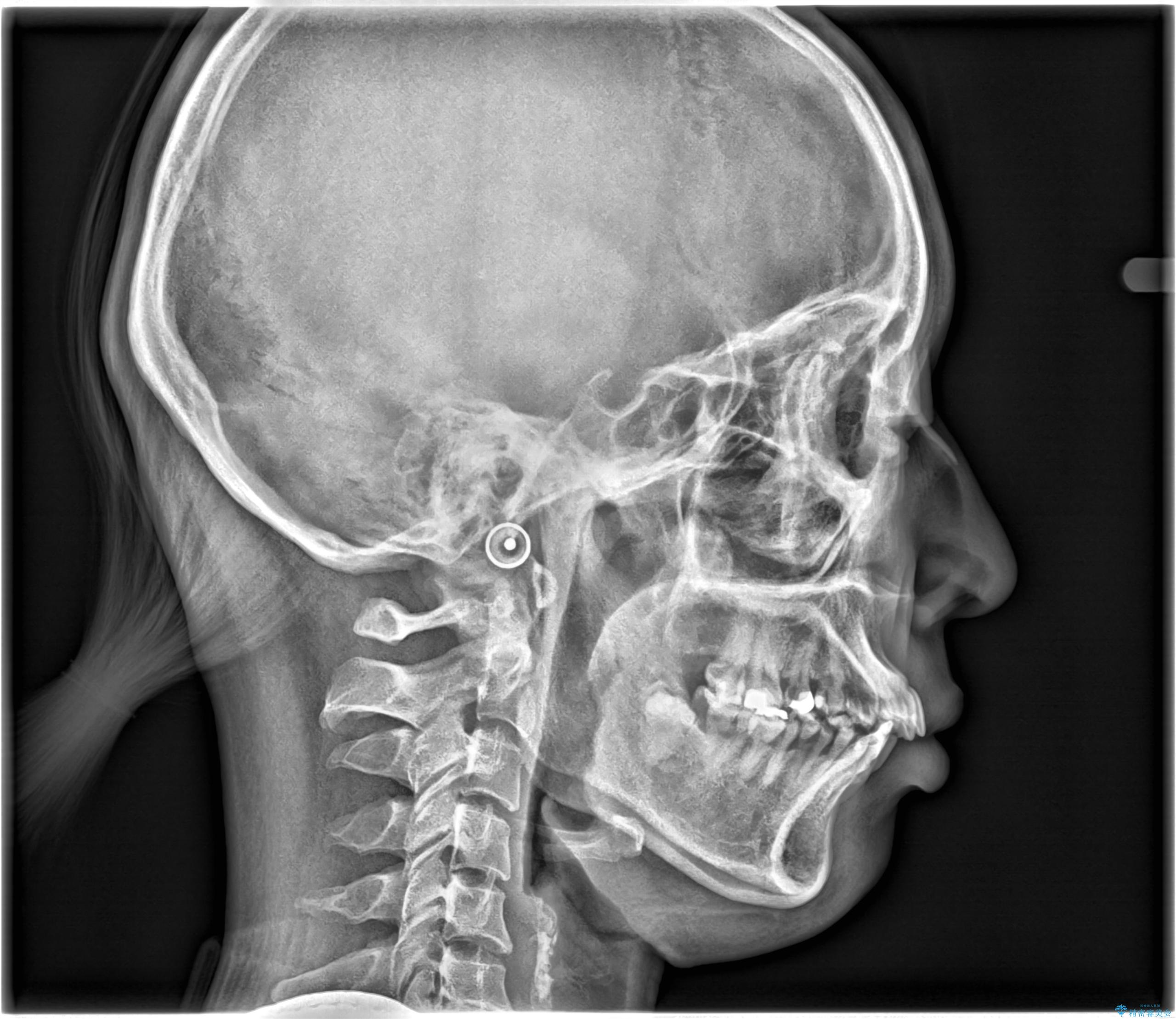 【ワイヤー矯正】前歯の凸凹を治したいの治療前(顔貌)