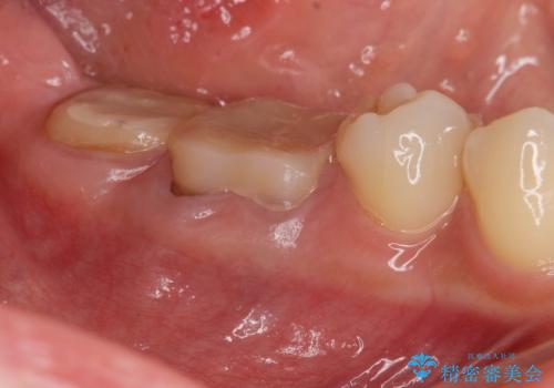 スペース狭小な銀歯を白くしたい 歯冠長延長術を併用したセラミック治療の治療中