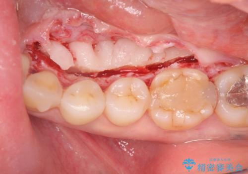 話すのに邪魔な、下顎骨隆起の切除の治療中