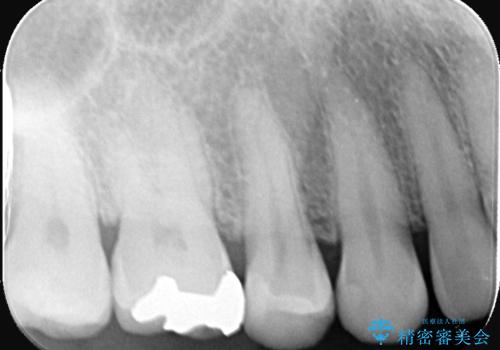 セラミックインレー 虫歯の治療の治療後