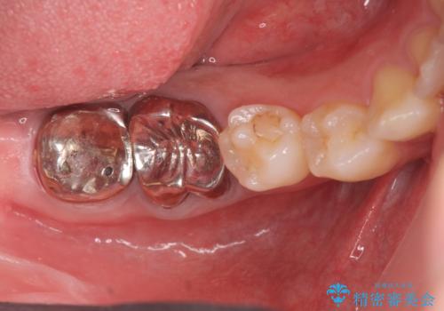 スペース狭小な銀歯を白くしたい 歯冠長延長術を併用したセラミック治療の治療前