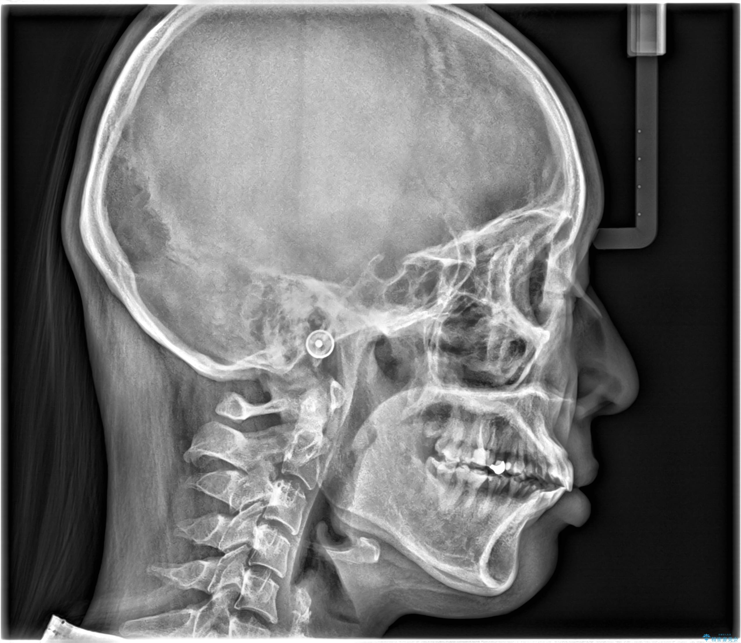 【ワイヤー矯正】前歯の凸凹を治したいの治療後(顔貌)