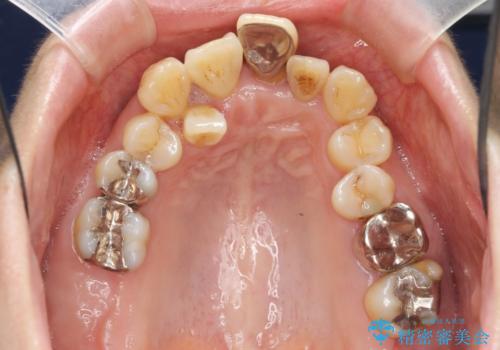 歯周病 、インプラント、 矯正 全顎治療の治療前