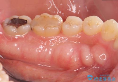 話すのに邪魔な、下顎骨隆起の切除