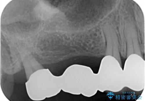 ブリッジのぐらつき インプラントを用いた奥歯の噛み合わせの再構築の治療前