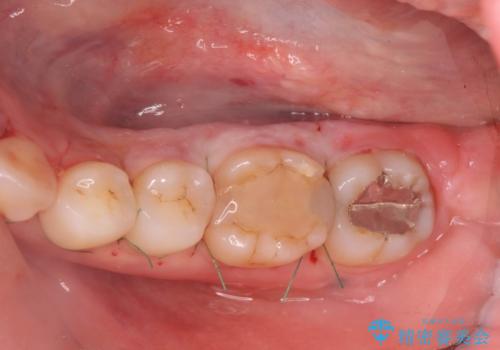 話すのに邪魔な、下顎骨隆起の切除の治療後