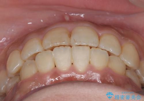 【ワイヤー矯正】前歯の凸凹を治したいの治療後