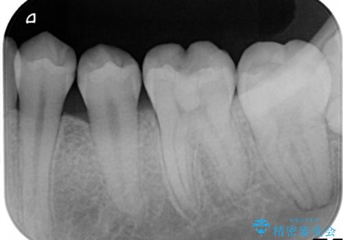 左下小臼歯|接触面カリエスに対するセラミックインレー修復の治療前