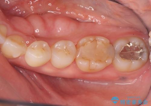 話すのに邪魔な、下顎骨隆起の切除の治療前