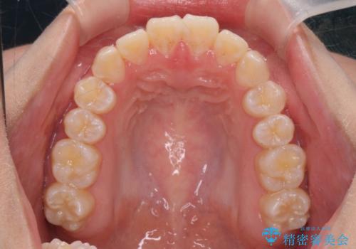 上下すれ違った前歯の矯正治療の治療後