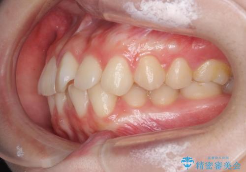 前歯のねじれをマウスピース矯正で治したいの治療前