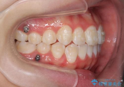 上下すれ違った前歯の矯正治療の治療中